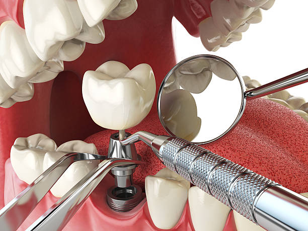 Best Emergency Dentist for Knocked-Out Tooth in North Brooksville, FL