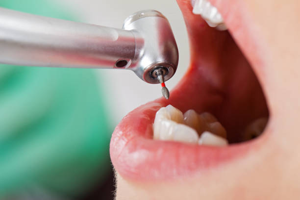 Best Emergency Dental Care for Abscessed Tooth in North Brooksville, FL